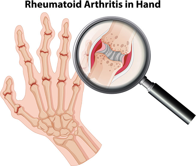 rheumatoid arthritis in hand